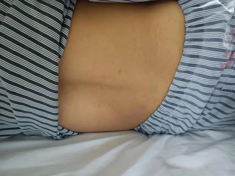 中藥熱奄包技術（干法）